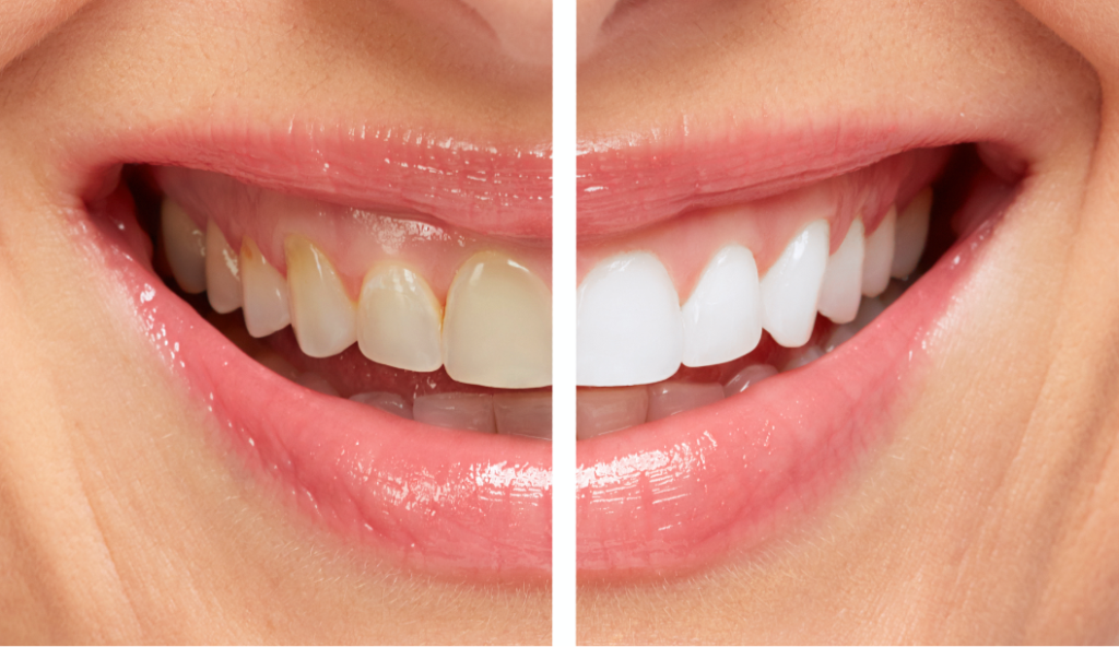 smile comparison - yellow vs. white teeth