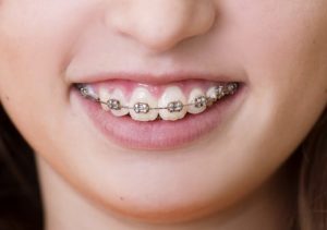 braces wearer wondering what candy to eat at Halloween