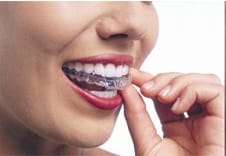 Bracing for the worst: What are my options for braces?